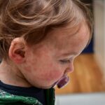Red rash on toddler's face and neck