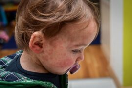 Red rash on toddler's face and neck