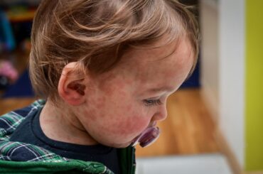 Red rash on toddler's face and neck