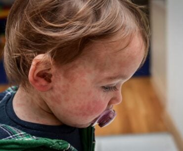 Red rash on toddler's face and neck