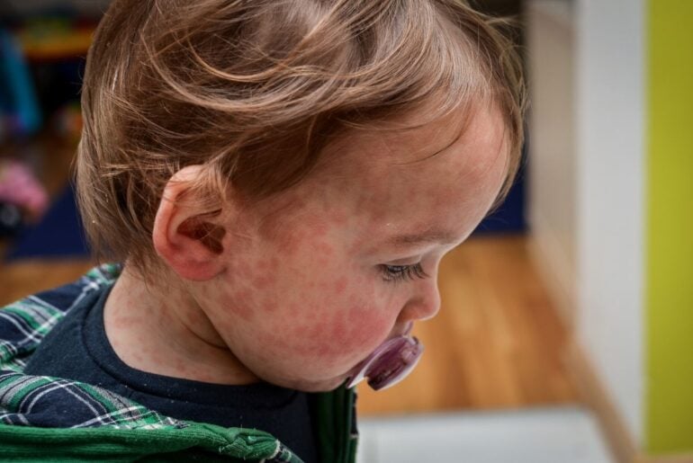 U.S. reaches highest number of measles cases in 35 years Red rash on toddler's face and neck